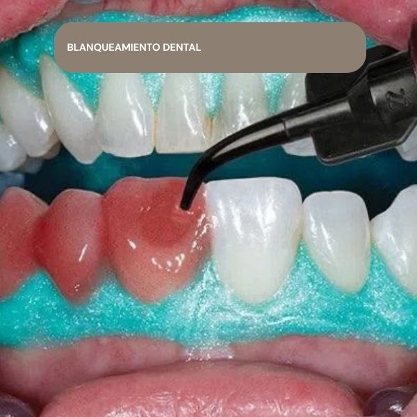 blanqueamiento dental