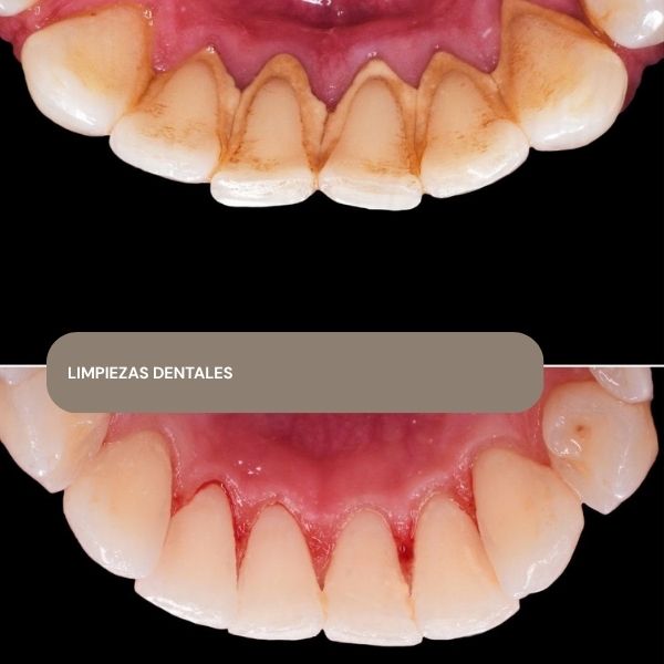 LIMPIEZAS DENTALES