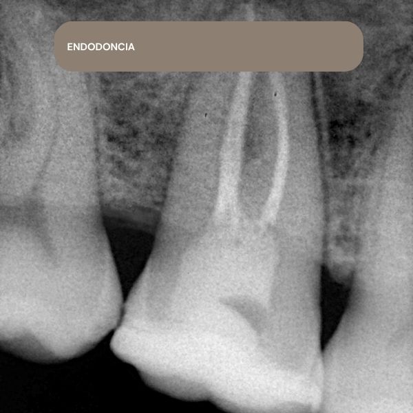 endodoncia