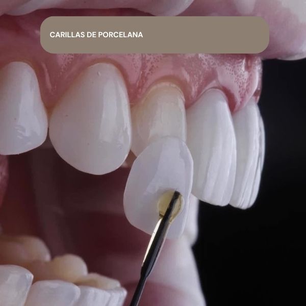 carillas de porcelana en panama